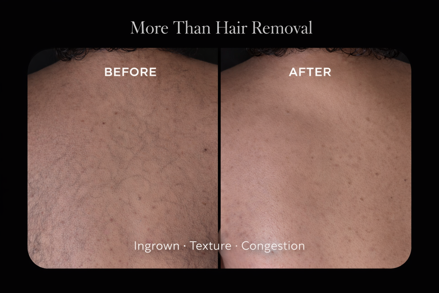 Professional sugaring hair removal results at GLOWY & BEYOND Santa Monica