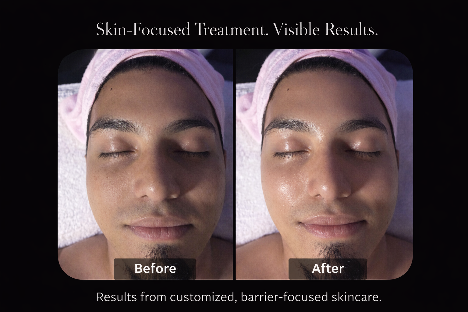 Facial skin treatment results at GLOWY & BEYOND Santa Monica